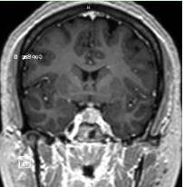 核磁共振成像上可见的垂体瘤